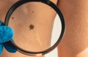 Cuba desarrolla tratamiento para el cáncer de piel, en medio de crisis