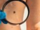 Cuba desarrolla tratamiento para el cáncer de piel, en medio de crisis