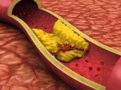 La aterosclerosis puede provocar infartos y accidente cerebrovascular
