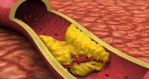 La aterosclerosis puede provocar infartos y accidente cerebrovascular