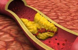 La aterosclerosis puede provocar infartos y accidente cerebrovascular
