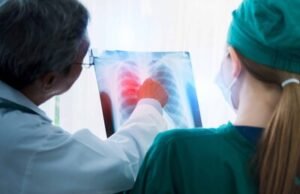 La importancia del diagnóstico precoz del cáncer pulmonar